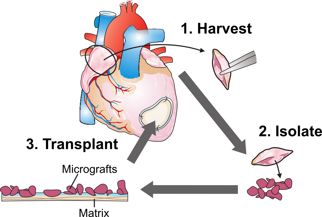 Cardiac Micrograft Therapy graphic