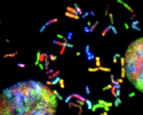 Brain cancer chromosomes